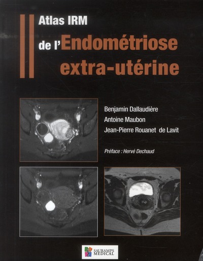 ATLAS IRM DE L´ENDOMETRIOSE EXTRA-UTERINE